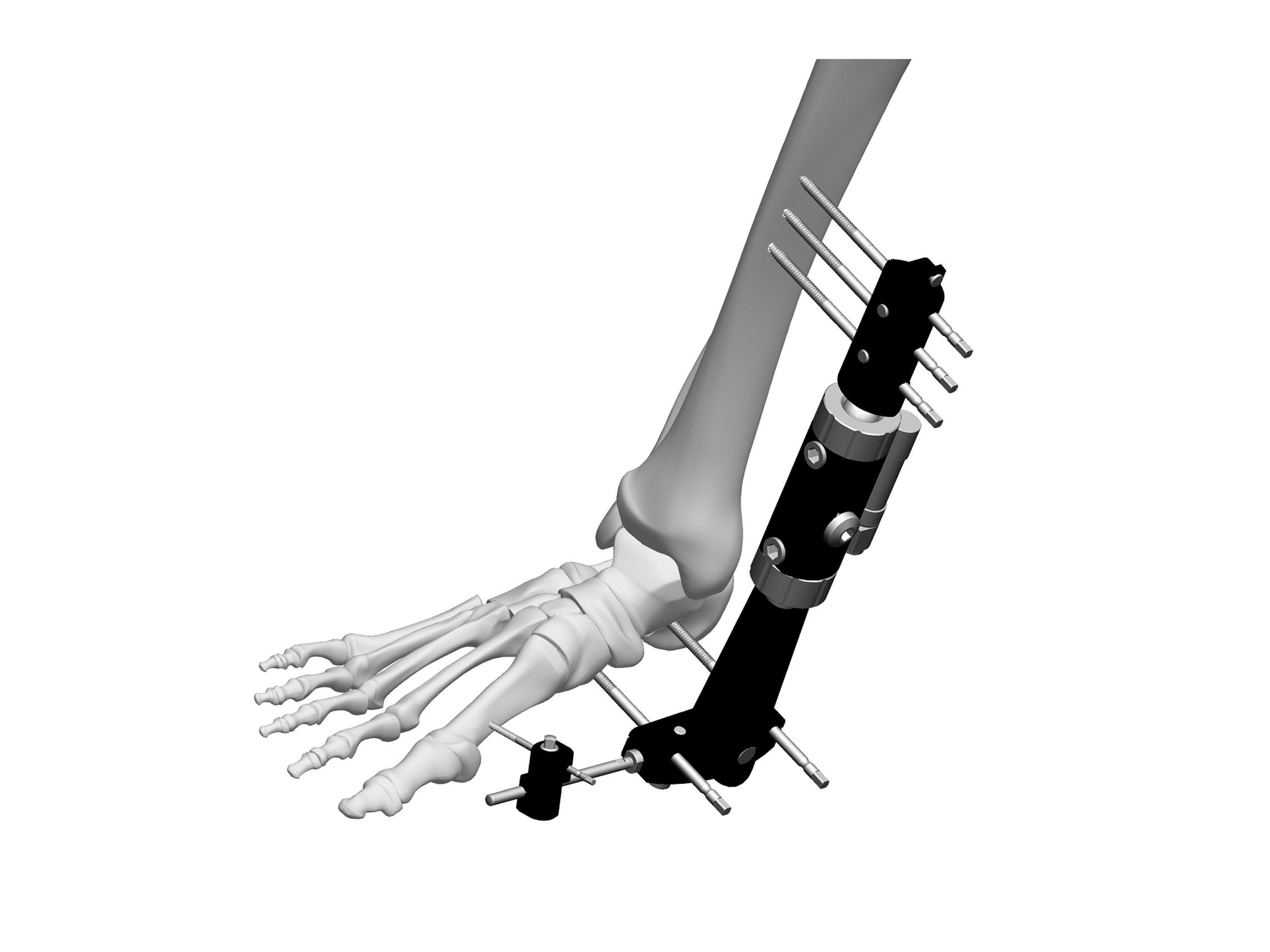 Ankle joint fixator