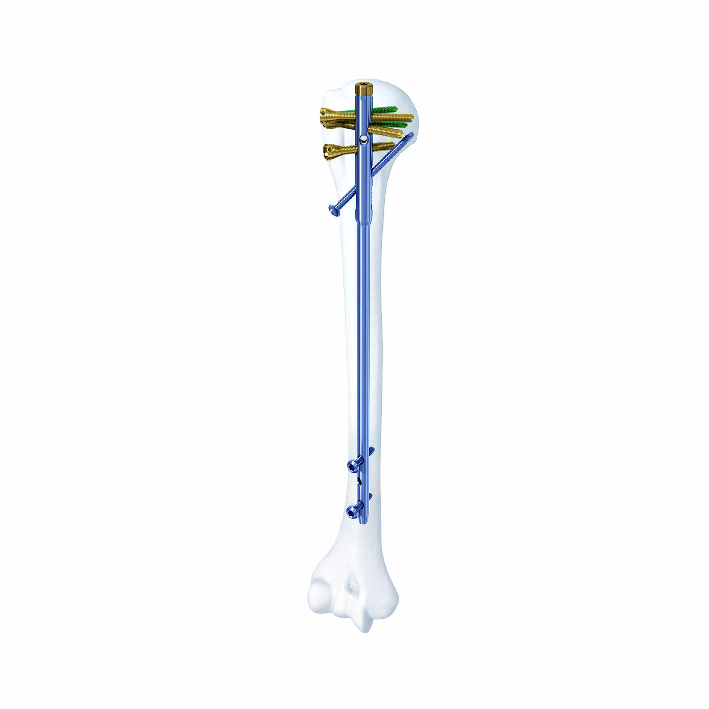 Humerus Multi-dimensional Locking Intramedullary Nail