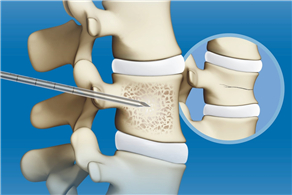 Vertebroplasty(PVP)