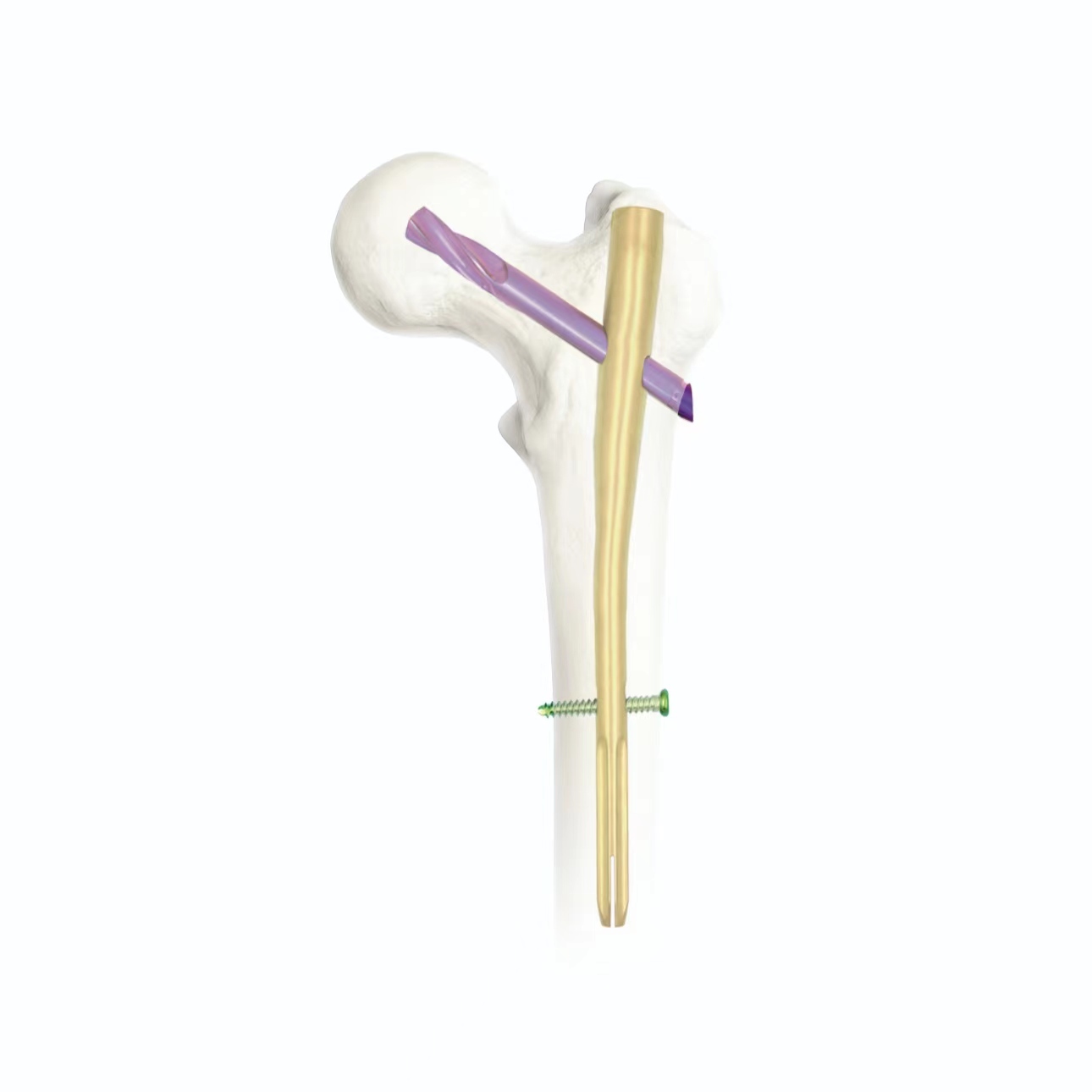Proximal Femur Intramedullary Nail