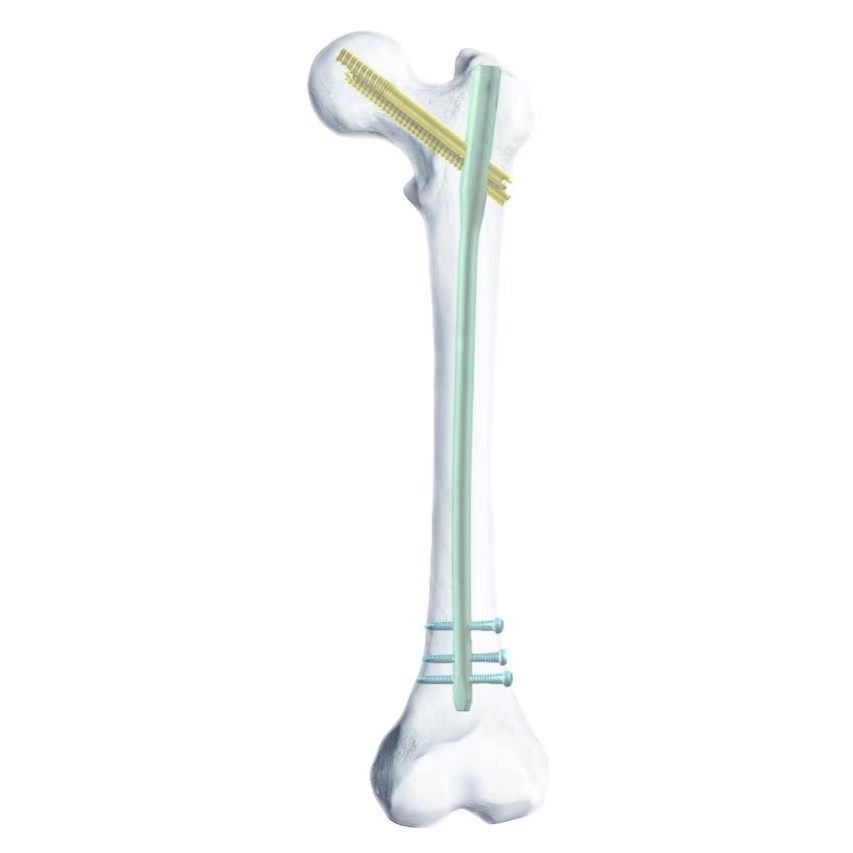 Femoral Interlocking Intramedullary Nail