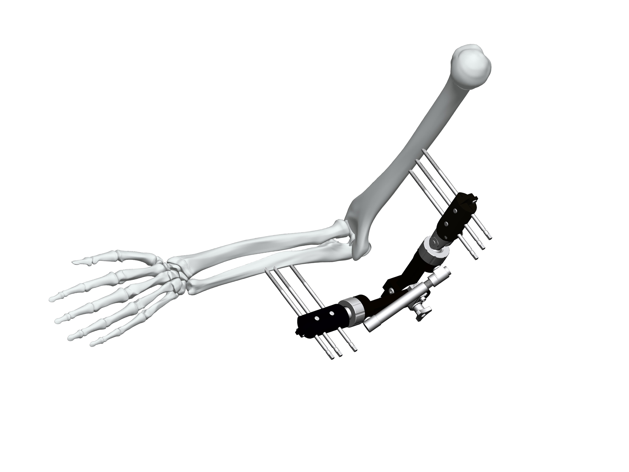 Arm Abduction Fixer
