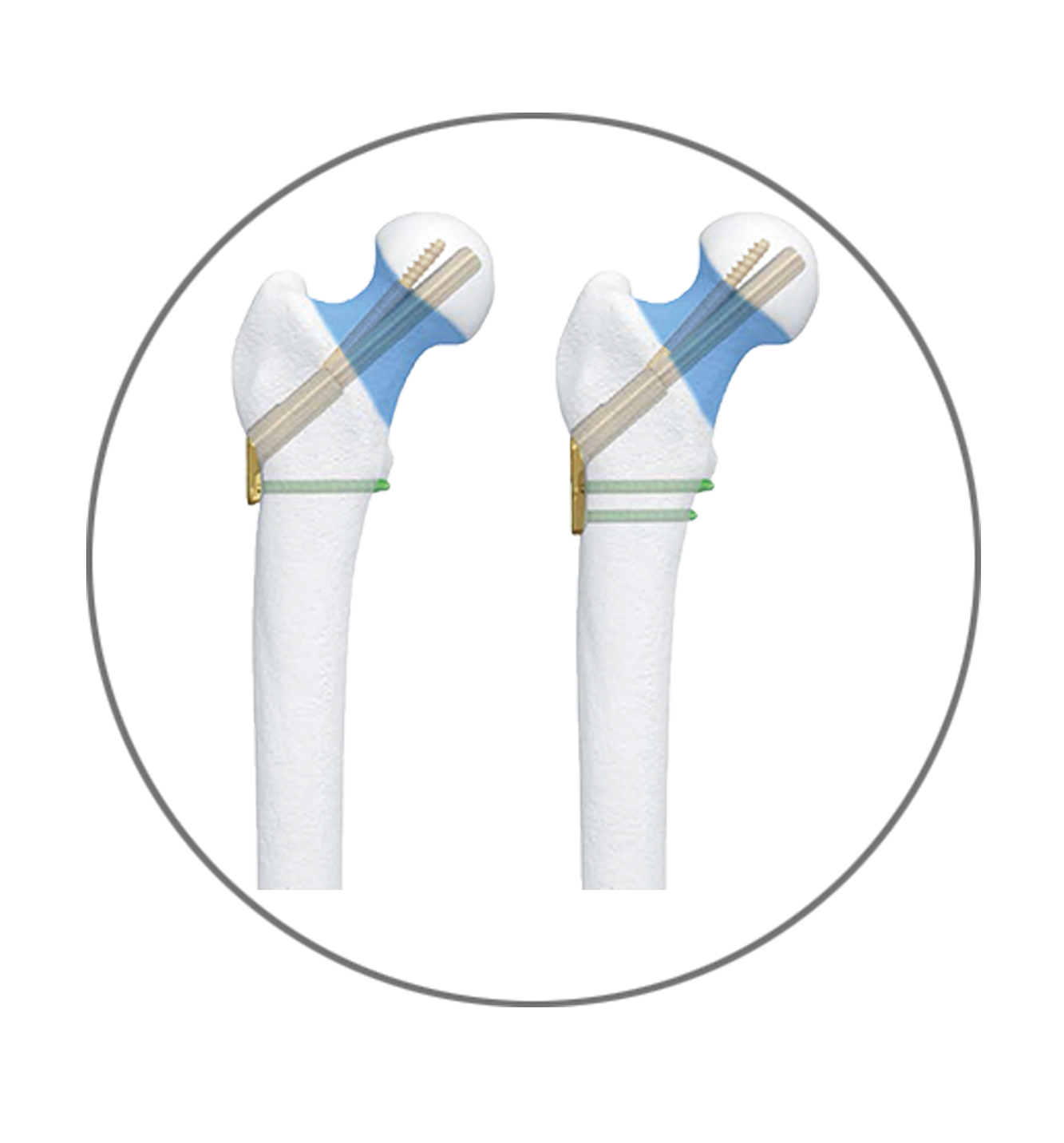 Femoral Neck Dynamic Cross Nail System